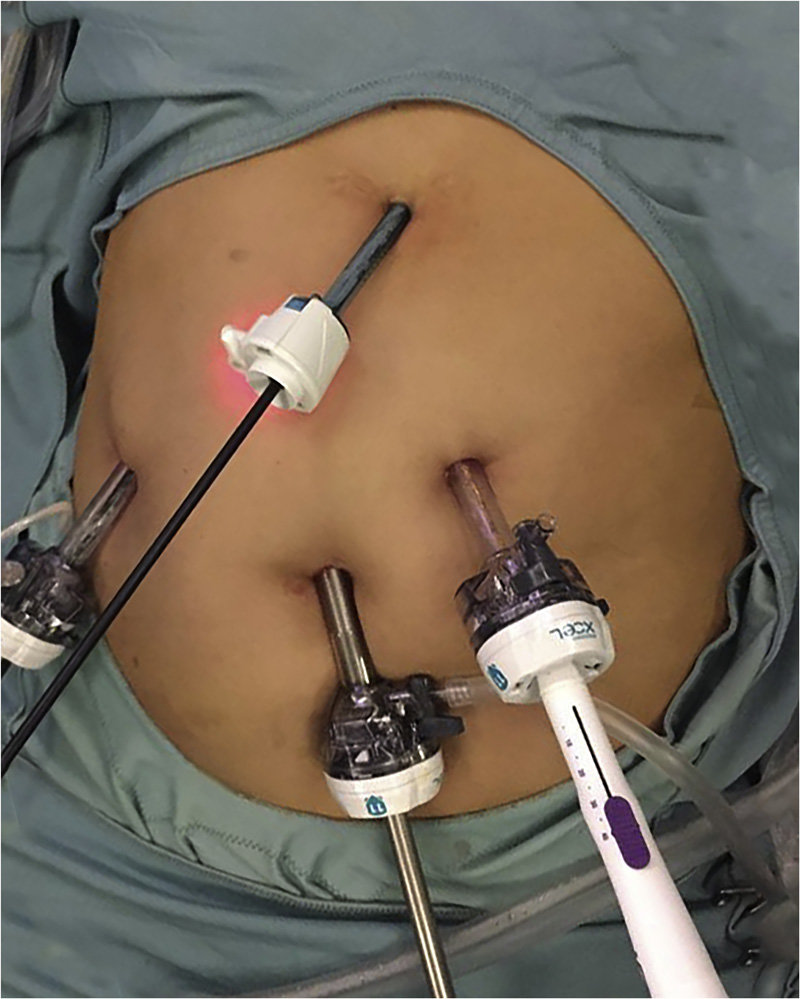 https://www.researchgate.net/profile/Roberta-Angelico/publication/333327709/figure/fig2/AS:766017164832772@1559644132573/Trocar-position-for-laparoscopic-liver-resection-Surgery-was-performed-by-the-insertion.jpg