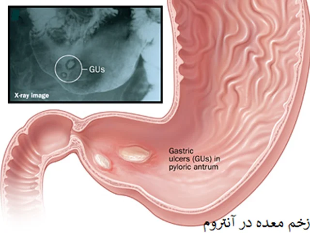 بیماری زخم گوارشی یا زخم پپتیک (Peptic Ulcer Disease)